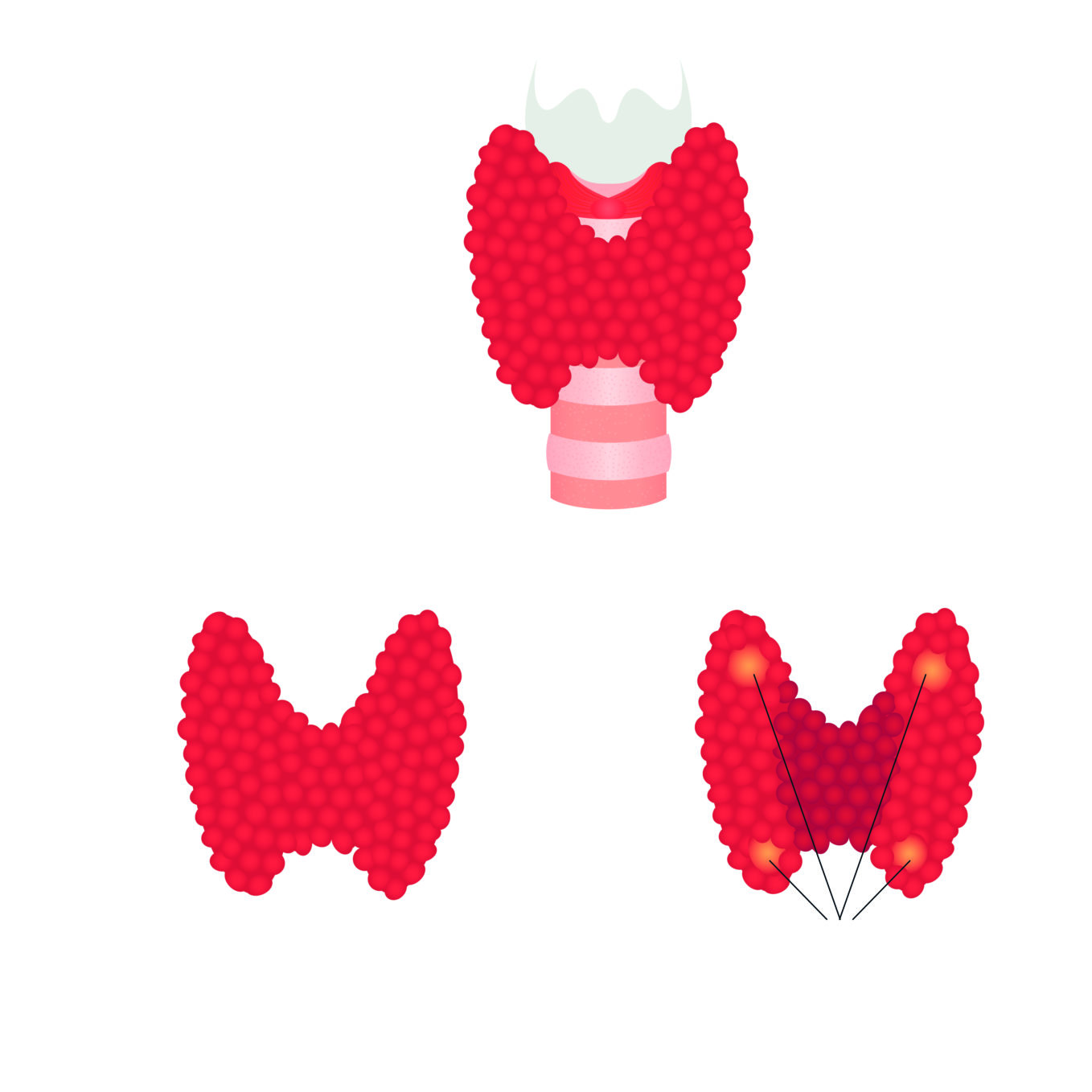 Meine OP SchilddrüsenEntfernung klinikguide.at Gesundheit finden